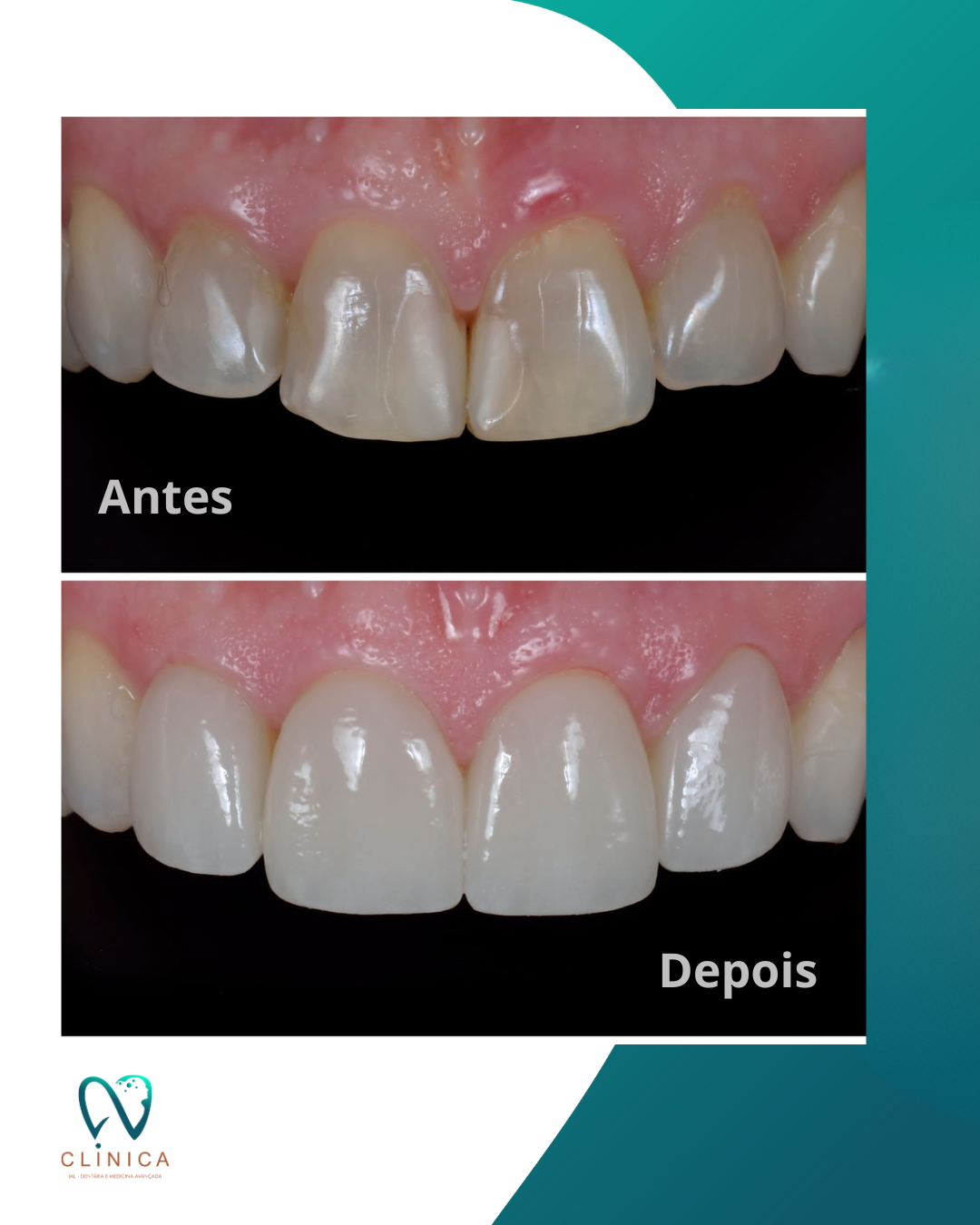 Antes e depois de tratamento estético dentário na Clínica IAL
