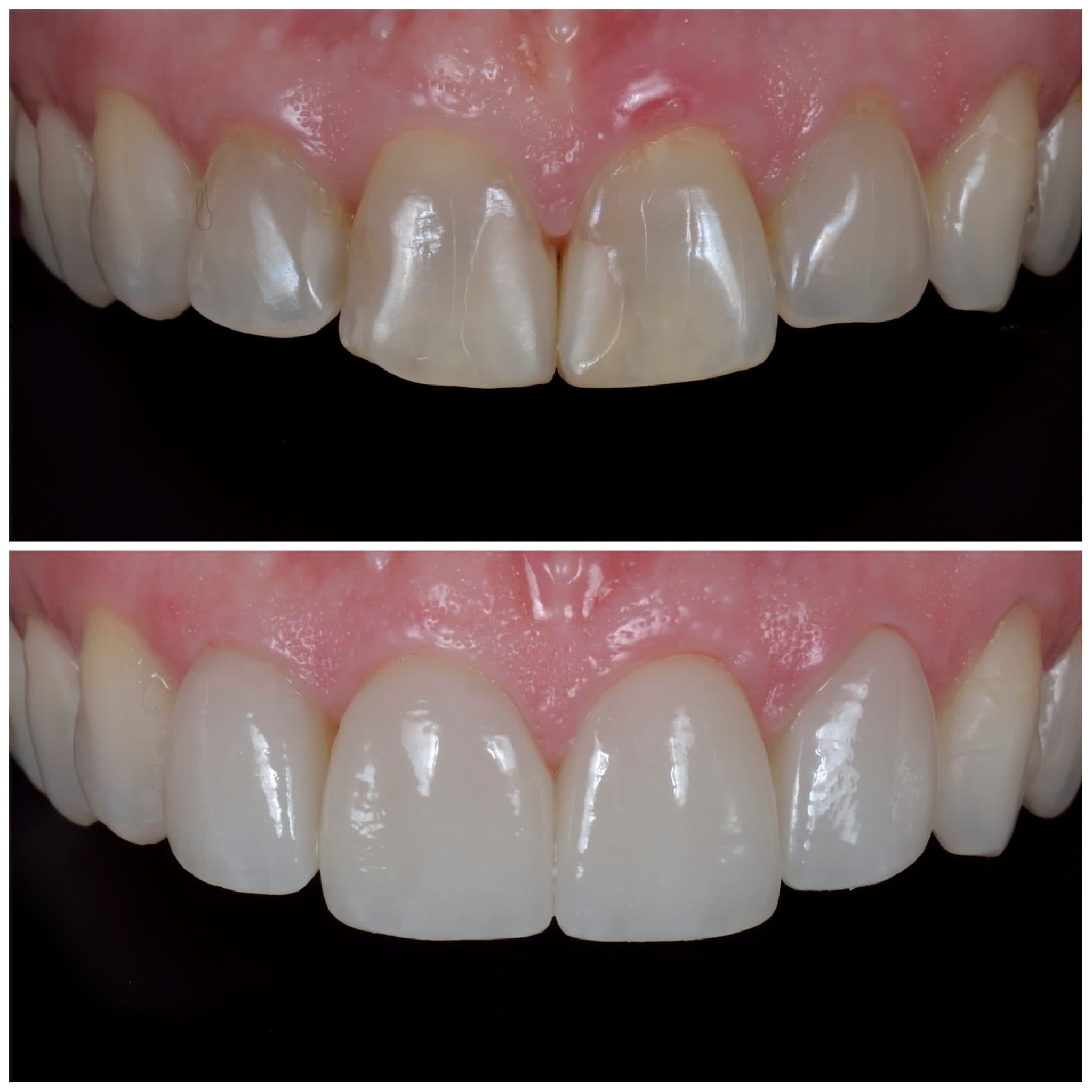 Caso clínico antes e depois de estética dentária